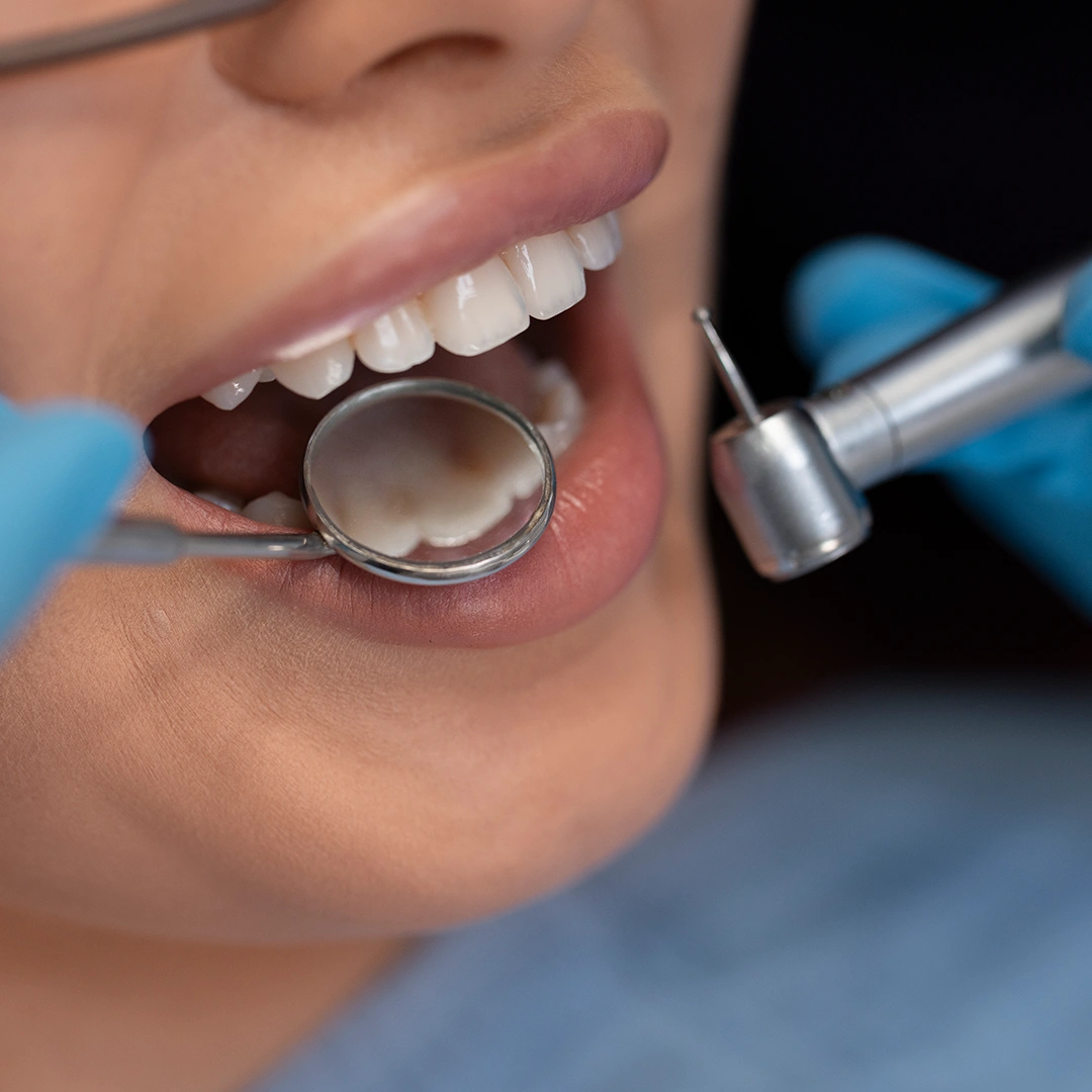 Cosmetic Fillings